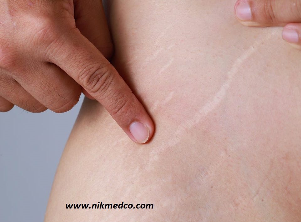 stretch marks استرچ مارک