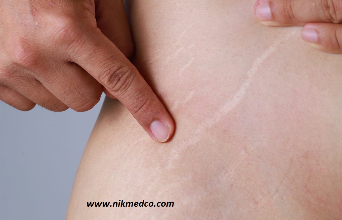 stretch marks استرچ مارک