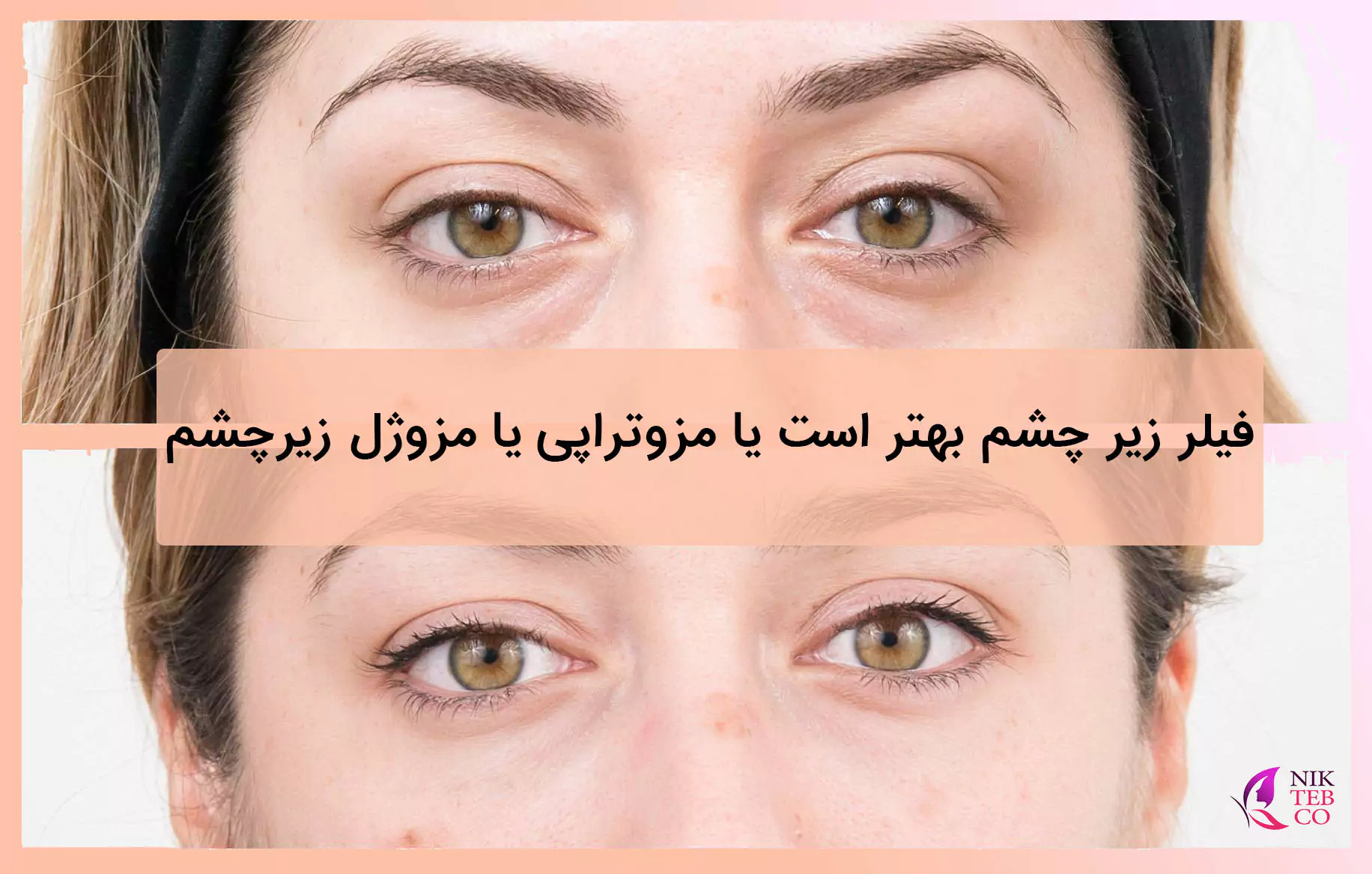 فیلر زیر چشم بهتر است یا مزوتراپی یا مزوژل زیرچشم