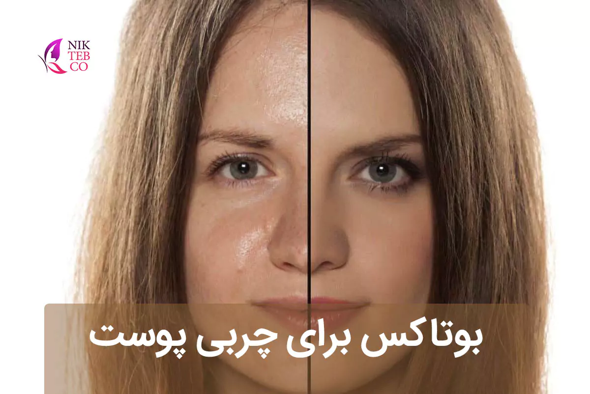 بوتاکس پوست چرب