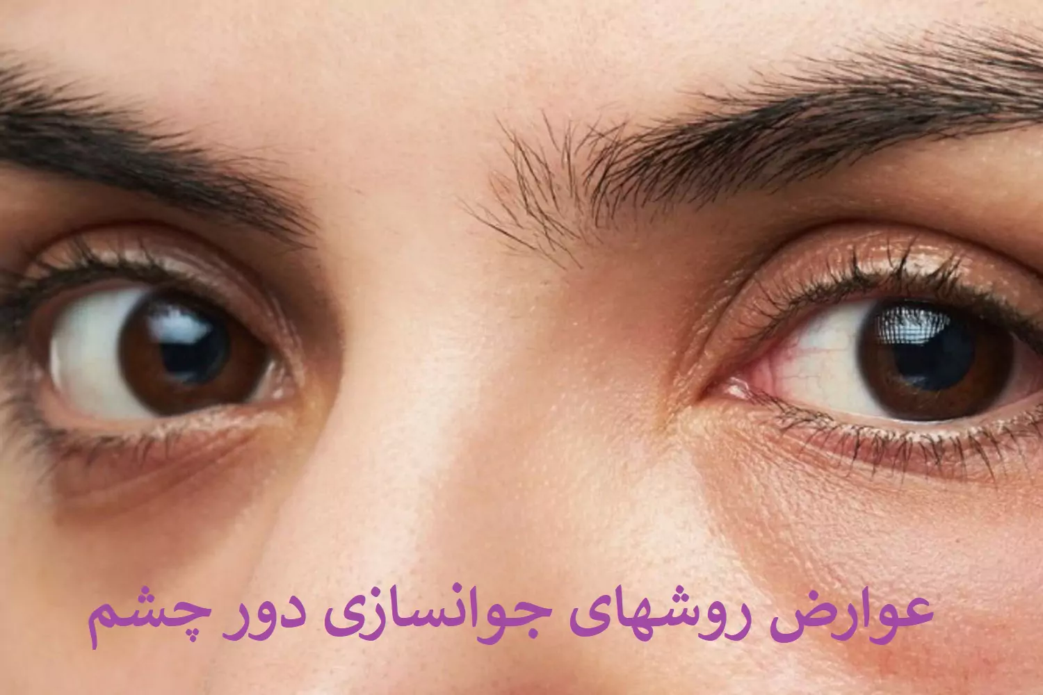 عوارض روشهای جوانسازی دور چشم